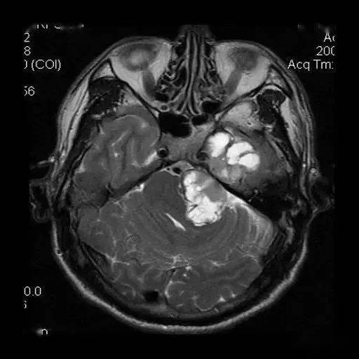 三叉神经瘤图片