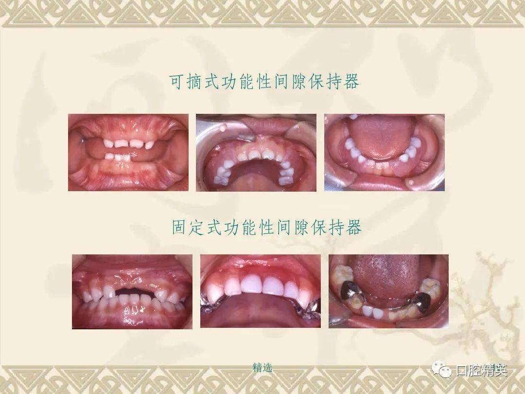 間隙保持器的設計和製作