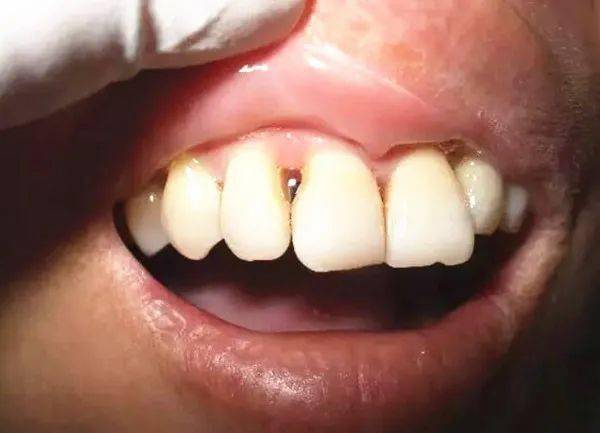 牙齿矫正后出现了黑三角牙龈萎缩的情况还有救吗