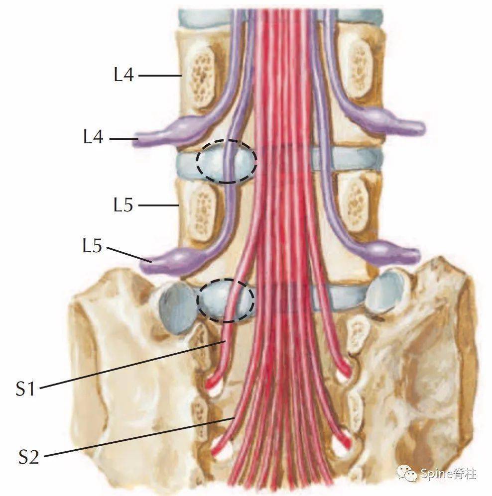 常见腰椎间盘突出与脊神经关系
