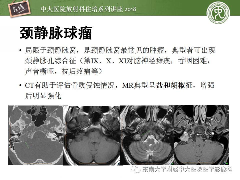 中耳解剖及中耳病變影像診斷