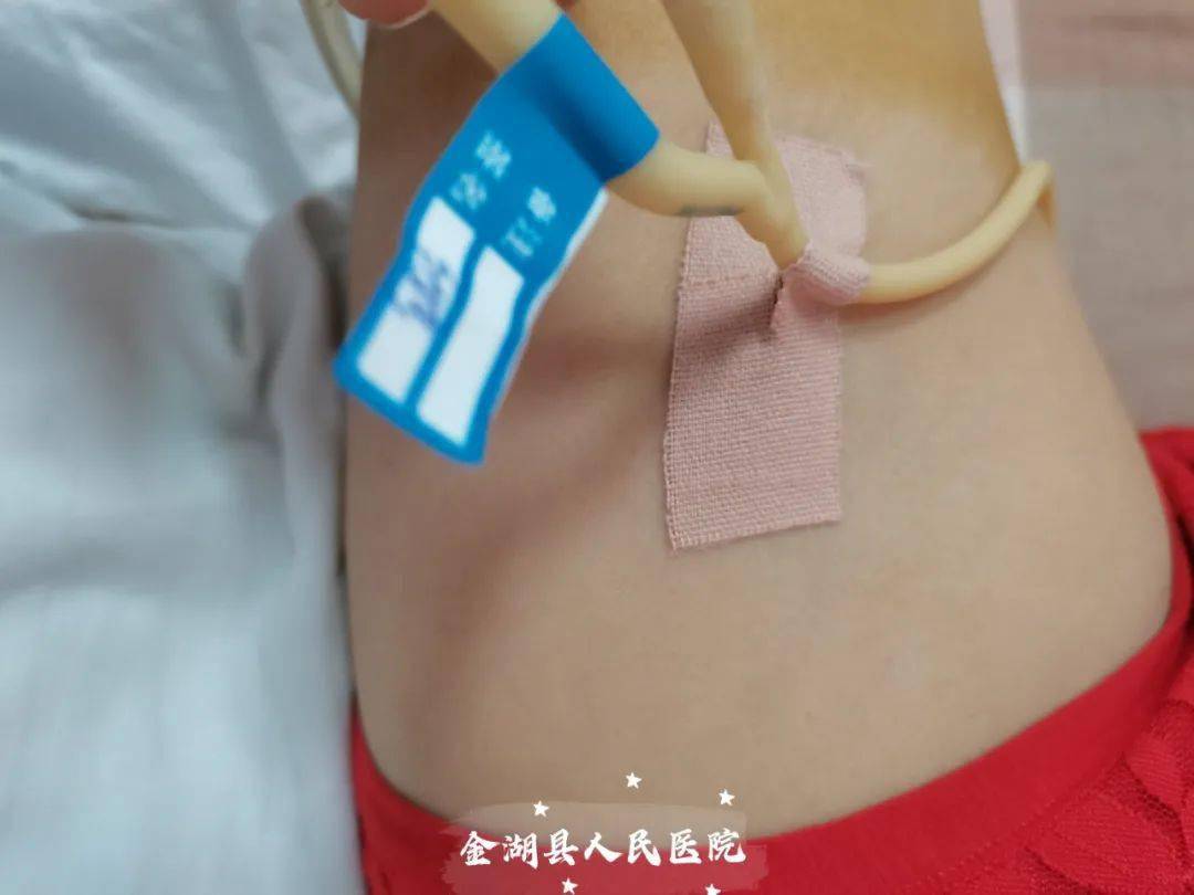 巧用3m宜拉胶带制作导管固定贴安心贴