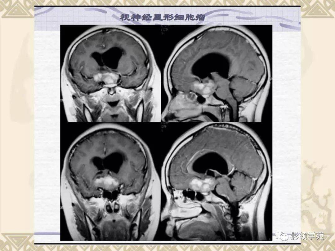 垂体病变的mri诊断