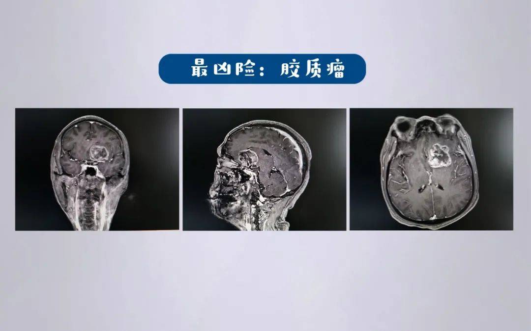 脑肿瘤也有良性和恶性之分,并不是所有的脑肿瘤都治不好,早期脑肿瘤