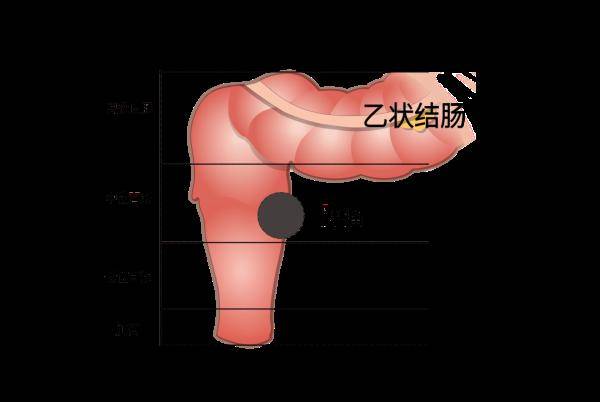 直腸癌早期並無症狀,日常預防尤為重要