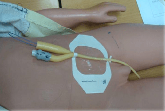 膀胱造瘘管固定图片图片