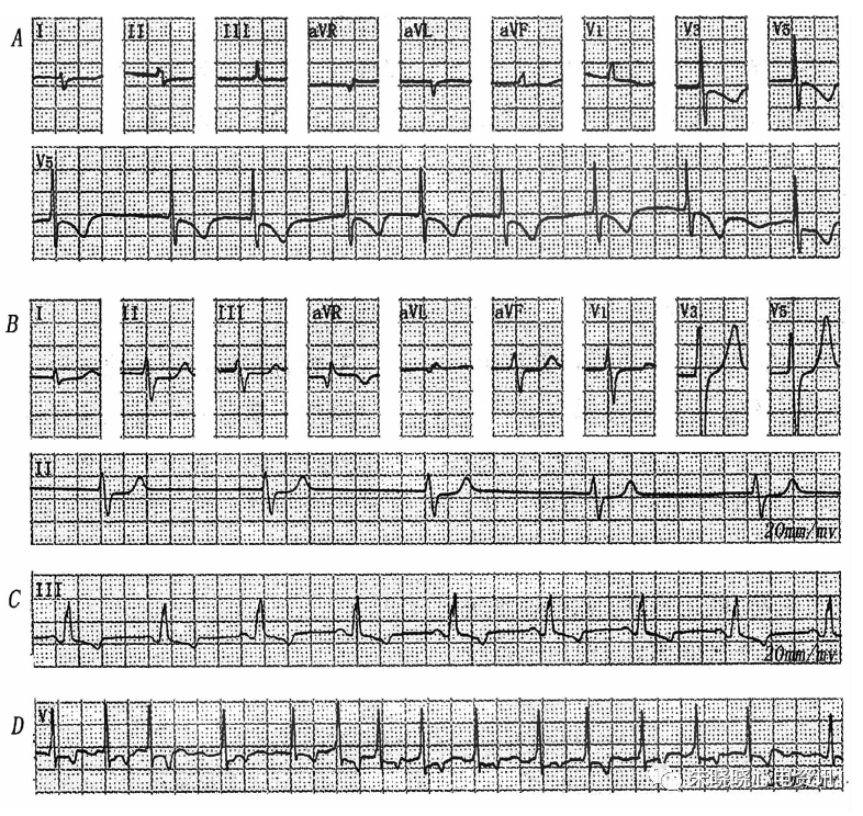 家兔高钾血症心电图图片