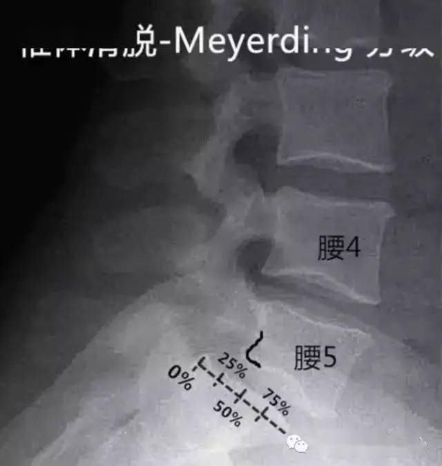 腰椎滑脫分度02下圖為骶椎腰化下圖為腰椎骶化此外腰