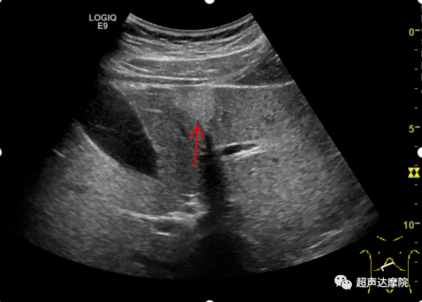 肝镰旁脂肪浸润_手机搜狐网