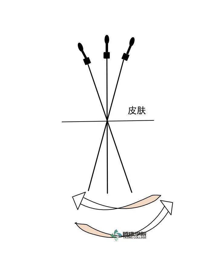 小针刀手法示意图图片