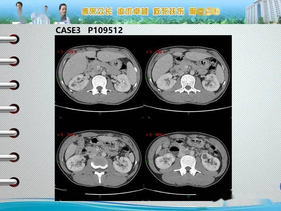髓质海绵肾的影像诊断