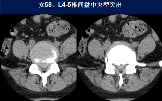 特色科室放射科腰椎ct诊断椎间盘突出椎管狭窄退行性改变