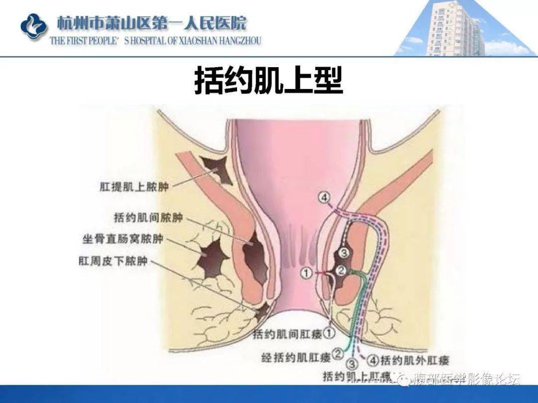 肛瘻是怎麼引起的?