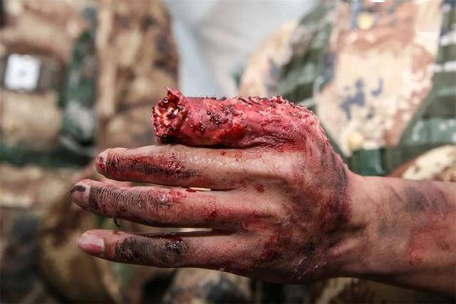 卫勤考核,来了_伤员