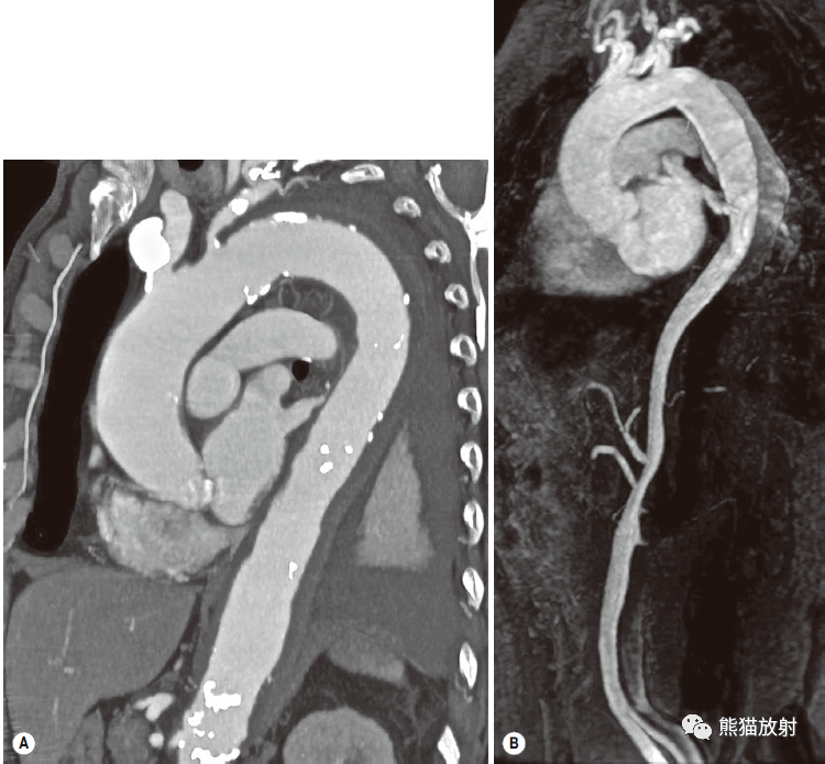 格艾選讀丨獲得性主動脈異常機理ct表現鑑別診斷