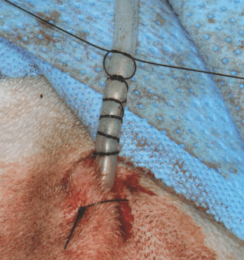 【图解】指套缝合技术