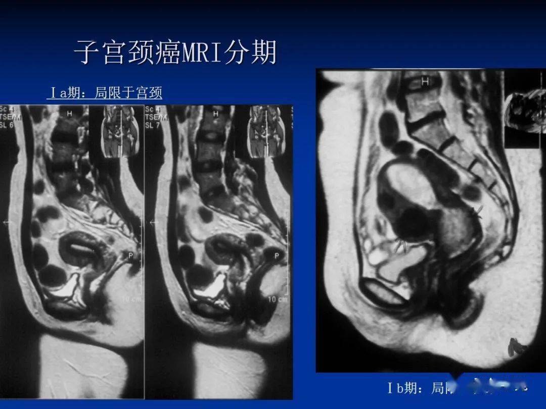 子宫恶性肿瘤的mr诊断