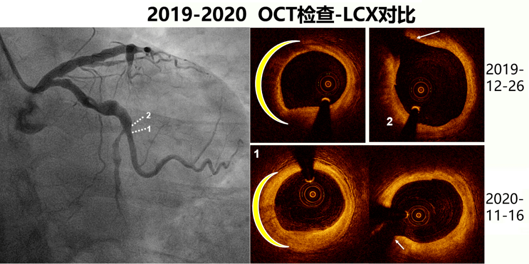 lad,rca以及lcx无明显狭窄,瘤样扩张同前无变化,复查oct检查示冠脉