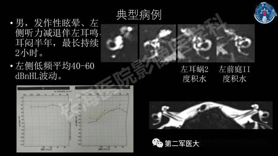 梅尼埃病內淋巴積水的mri表現