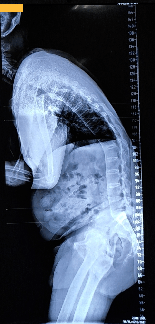 骨科团队倾力协作让折刀人重获新生