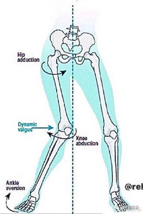 xo型腿的危害及改善,看完这篇就懂了