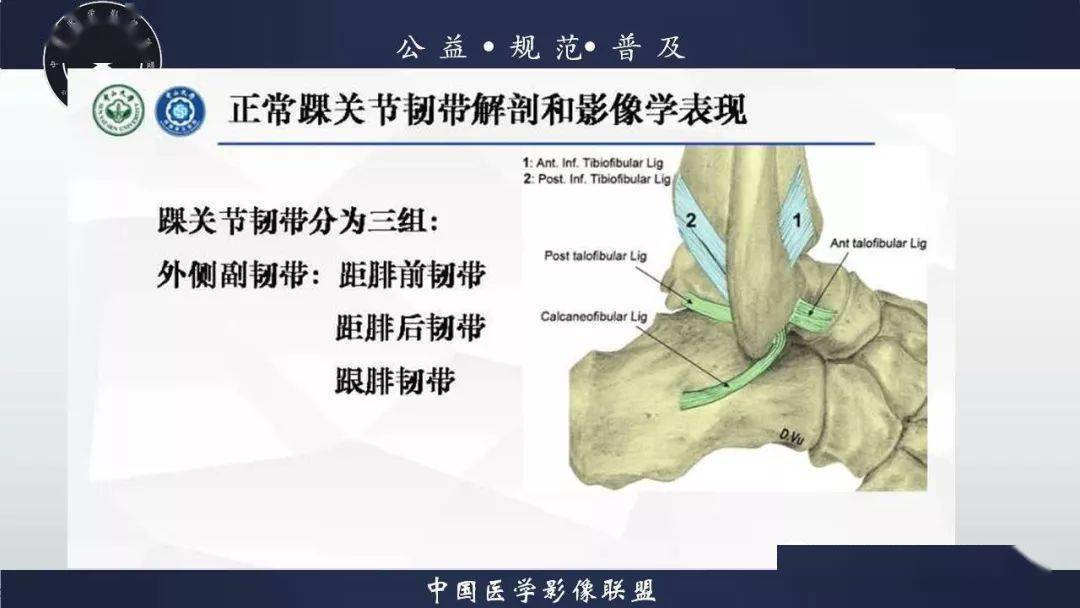 踝關節解剖及損傷mri診斷