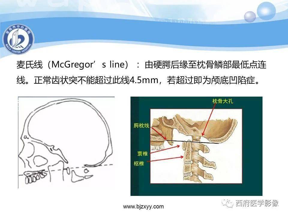 顱底凹陷症的影像診斷與鑑別診斷