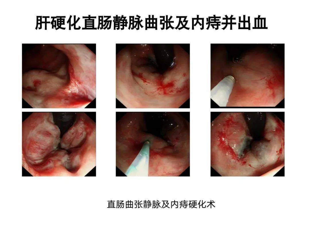 教学ppt内痔的内镜下硬化治疗经验分享