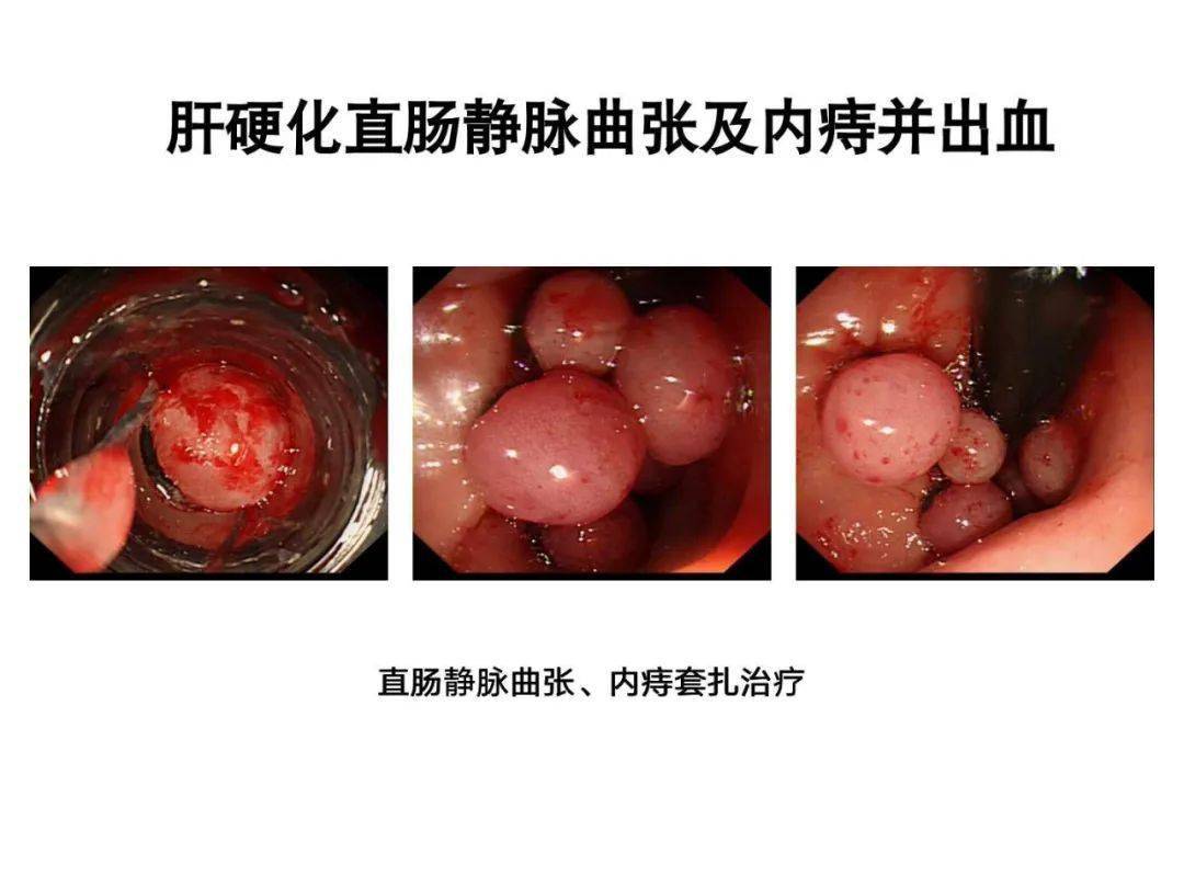 教学ppt内痔的内镜下硬化治疗经验分享