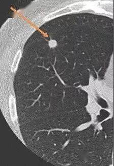 科普視窗丨ct提示肺結節莫緊張