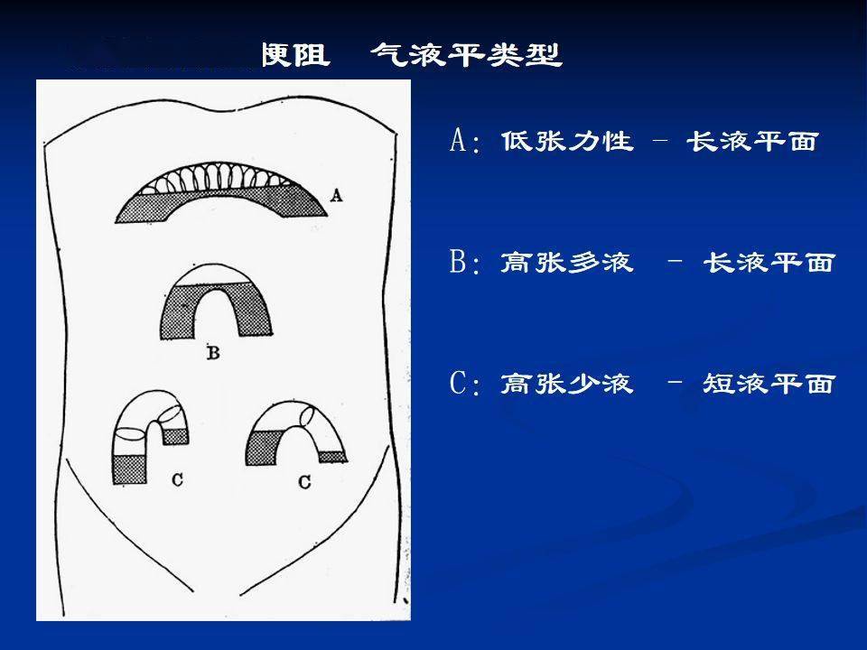 鱼肋征与阶梯状液平面图片