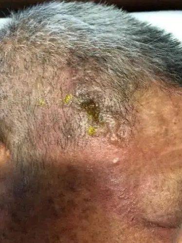 患者陈大伯因"右侧头面部疼痛4天,发现疱疹2天拟带状疱疹神经痛"收治