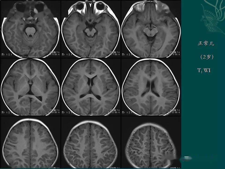 足月兒及嬰兒神經系統發育mri