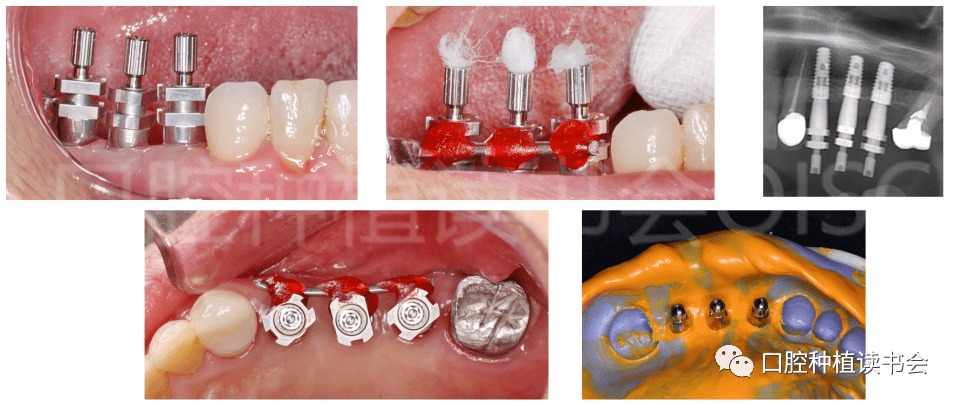 种牙上颌窦提升全过程图片