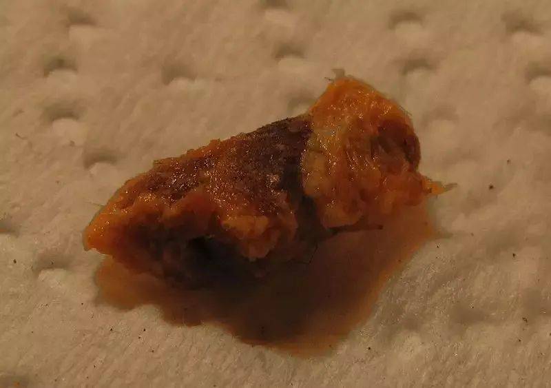 根据质地不同,耳垢可分为湿性耳垢和干性耳垢两种,湿性耳垢质地黏稠