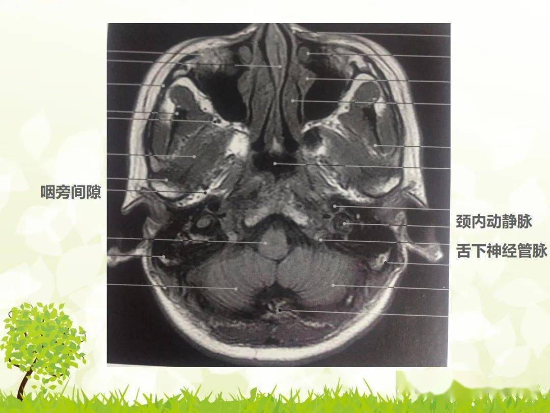 咽旁间隙解剖及常见病变影像表现