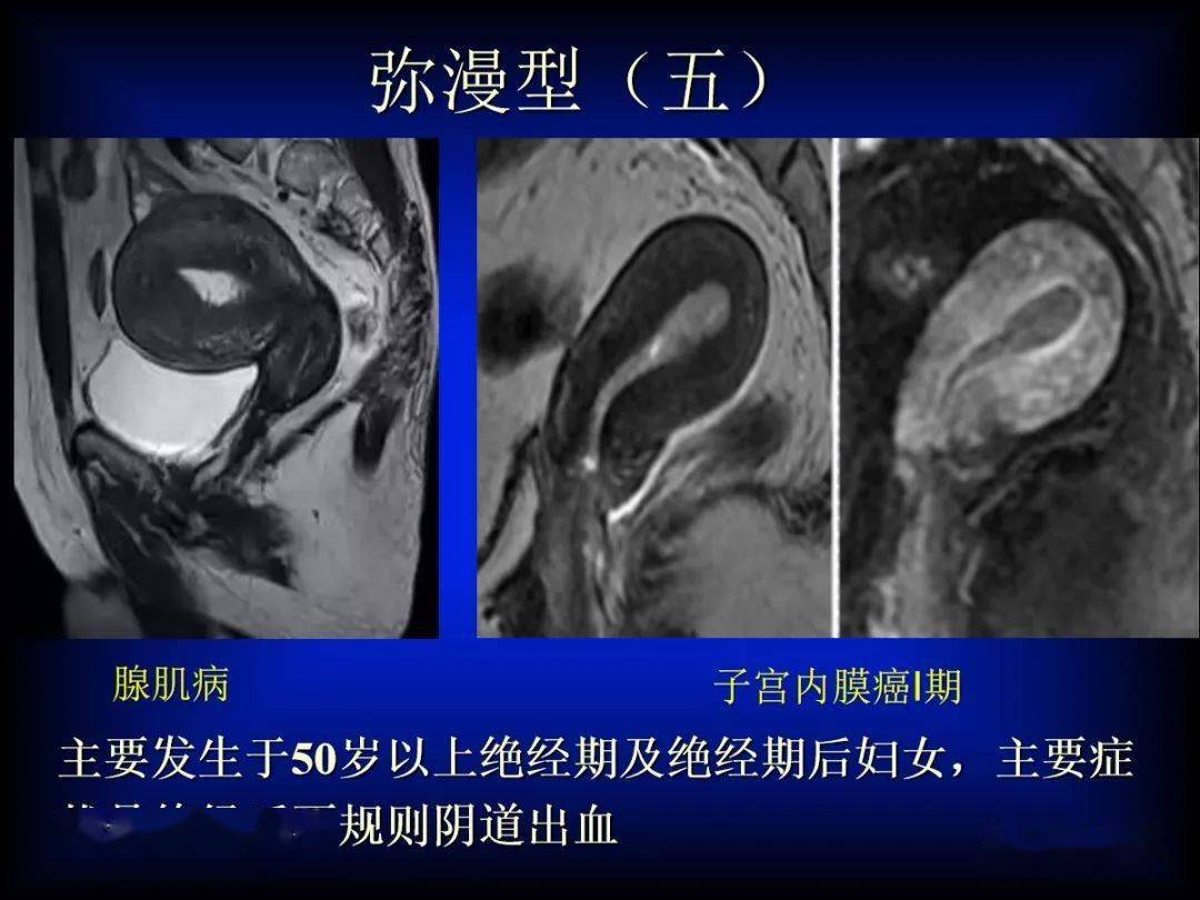 子宫腺肌症的mri表现