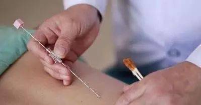 61 干针从以痛为腧演绎出了寻找肌肉的硬节点,压