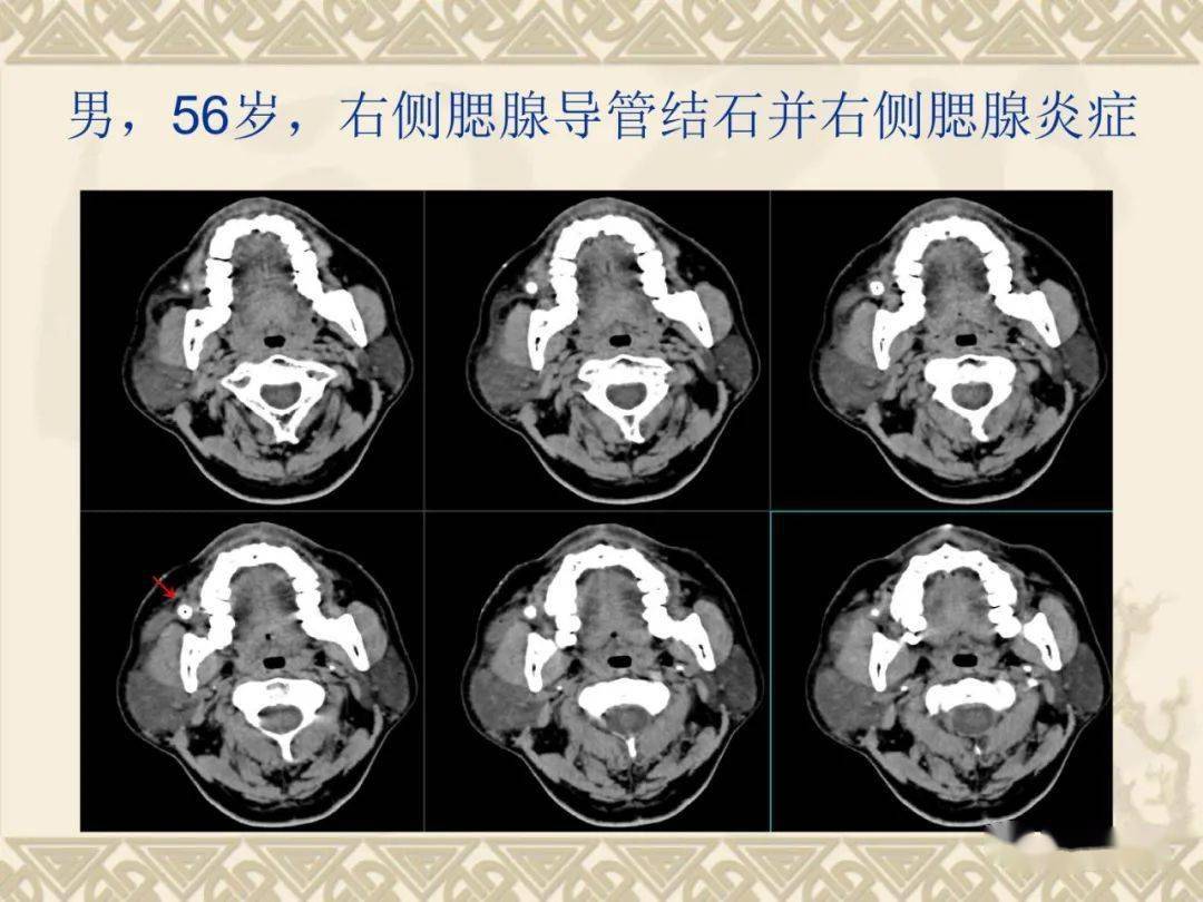 腮腺解剖及病变影像学表现