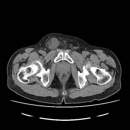 腹股沟炎性包块