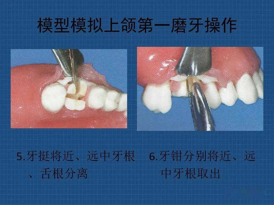 上下頜多根牙分根法