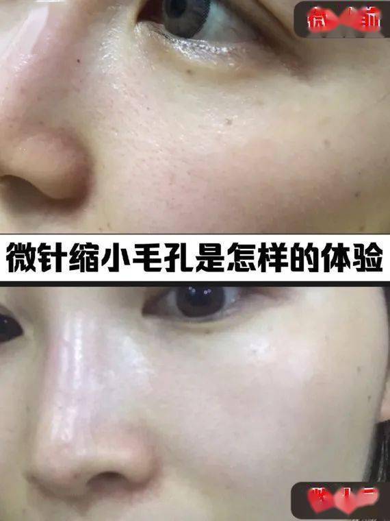 类人胶原蛋白微针缩小毛孔的真实体验_皮肤