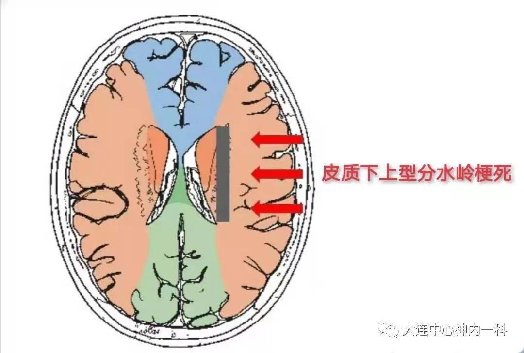 (3)皮质下上型分水岭梗死:大脑中动脉皮层支与豆纹动脉之间的分水岭