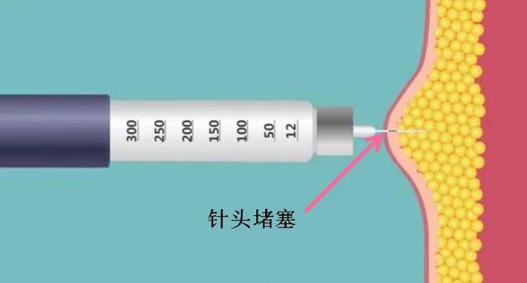 如上所述,您想將胰島素注射到皮下脂肪,腹部,大腿和臀部通常是糖尿病