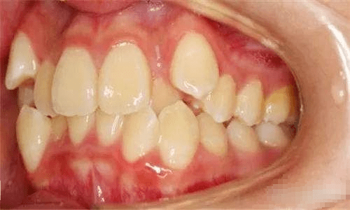 暂不处理;严重者,表现为个别或多个牙齿在各个方向的错位;而且牙齿