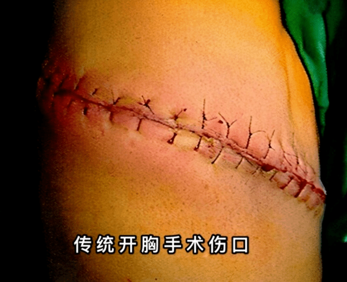 肋骨手术伤疤图片