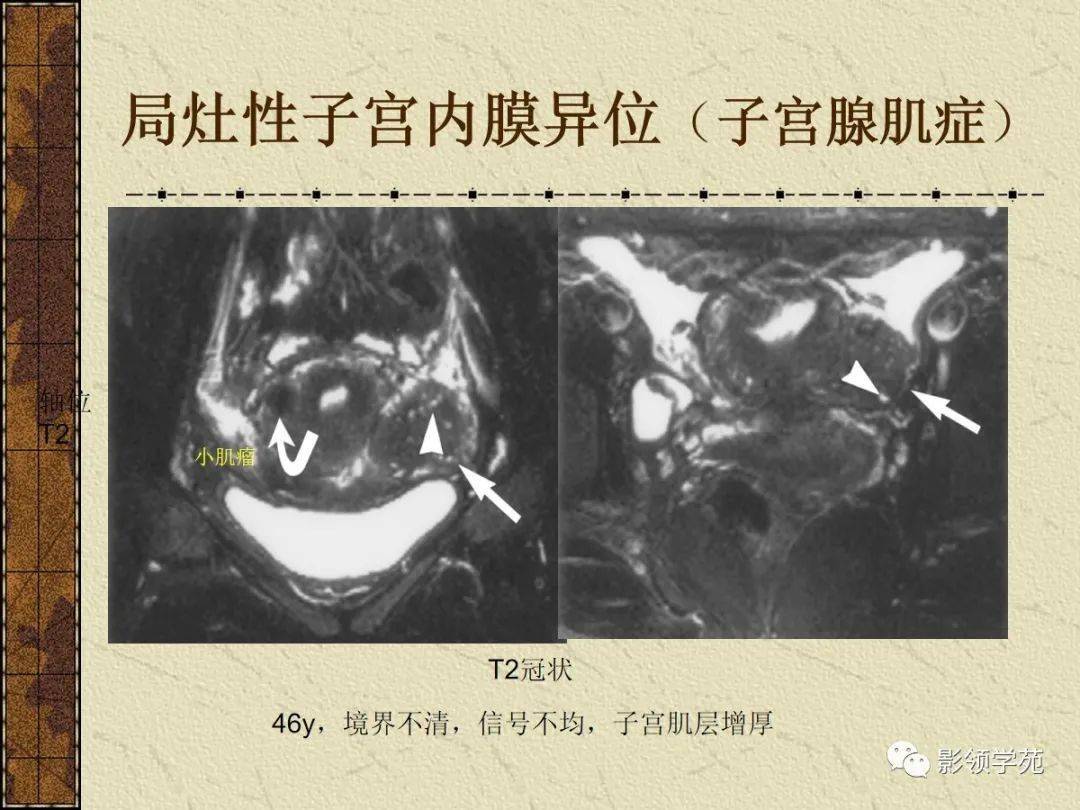 女性盆腔mri圖譜t2wi-sag t1wi-sag(增強)t2wi-sag子宮解剖卵巢及附件