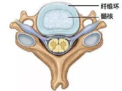 突出,膨出和脫出,細說腰椎間盤病