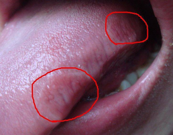 舌头两侧溃疡图片