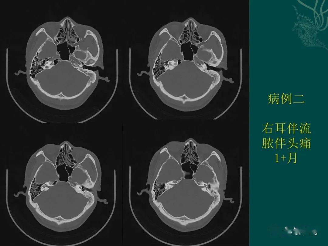 耳解剖及常見疾病影像表現